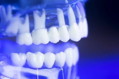 Diş hizalama diş modeli