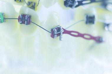 Diş diş parantez aligners