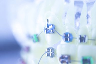 Diş diş parantez aligners