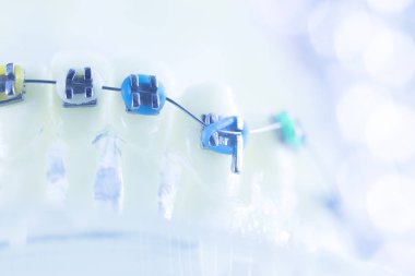 Diş diş parantez aligners