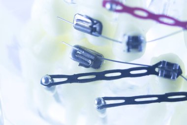 Diş diş parantez aligners