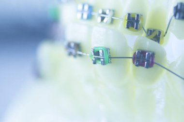 Diş diş parantez aligners