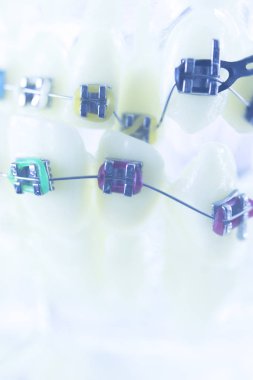 Diş diş parantez aligners