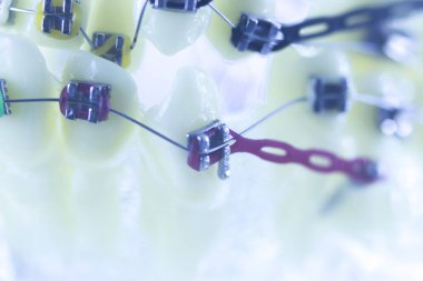 Diş diş parantez aligners