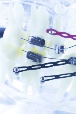 Diş diş parantez aligners