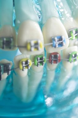 Diş diş köşeli metal