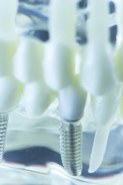 Diş titanyum implant diş