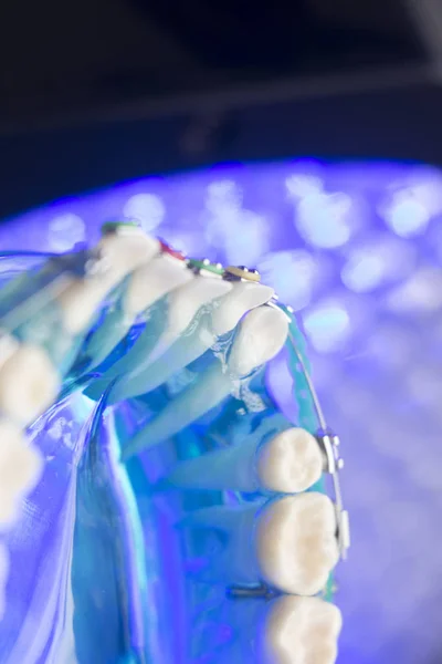 Denti dentali staffe metalliche — Foto Stock