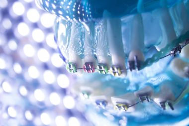 Diş diş köşeli metal