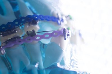 Diş diş köşeli metal