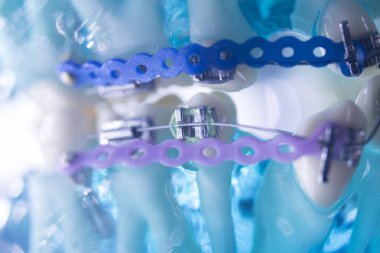 Diş diş köşeli metal