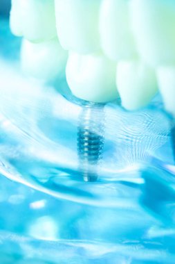 Diş titanyum implant diş