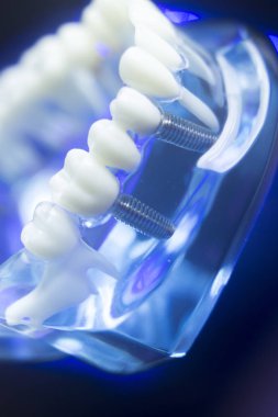 Diş diş çürümesi modeli