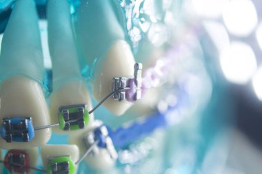 Diş diş köşeli metal