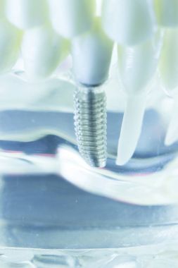 Diş titanyum implant diş