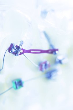 Diş diş parantez aligners