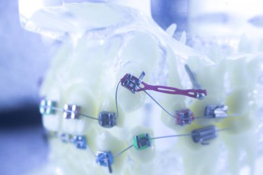 Diş diş parantez aligners