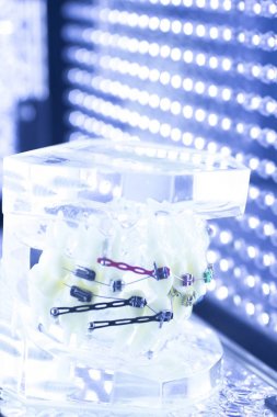 Diş diş parantez aligners