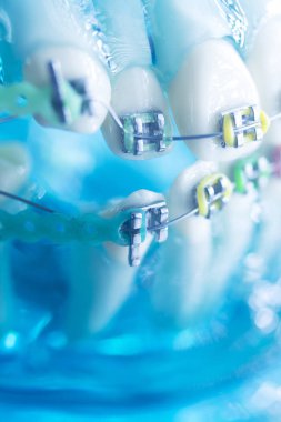 Diş diş köşeli metal