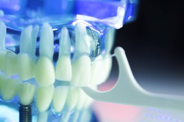 Diş diş hekimi impant