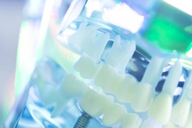 Diş diş hekimi impant