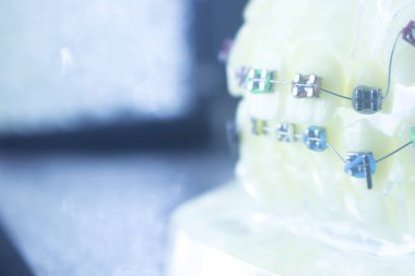 Diş diş parantez aligners