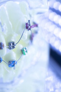 Diş diş parantez aligners