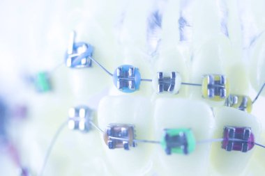 Diş diş parantez aligners