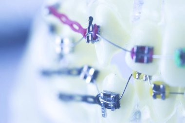 Diş diş parantez aligners