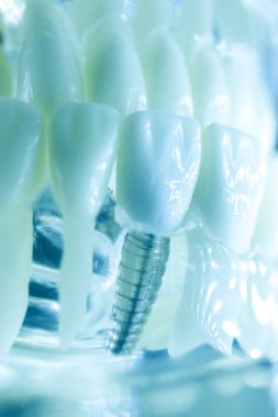 Diş titanyum implant diş