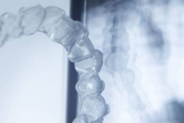 Görünmez diş aligner Düzleştiriciler