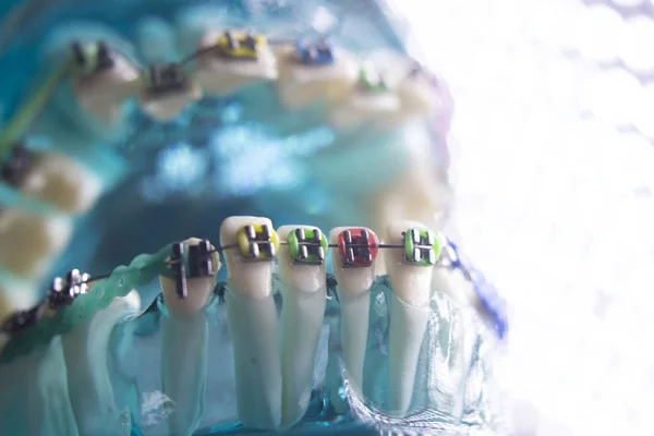 Dentes dentários suportes de metal — Fotografia de Stock