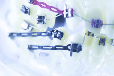 Ortodonti diş hekimleri öğretim modeli diş diş plastik ve metal köşeli parantez her diş düzleştirmek için aligners.