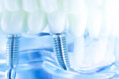 Diş titanyum estetik ortodontik diş implant diş hekimleri ağız diş modeli closeup izole.