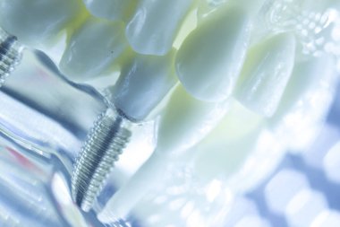 Diş titanyum estetik ortodontik diş implant diş hekimleri ağız diş modeli closeup izole.