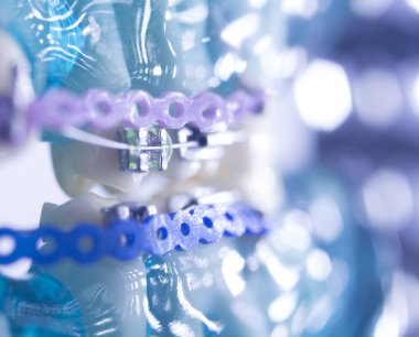 Ortodontik diş hekimliği tedavileri diş düzeltmek için aligners ayraç diş diş tutucular metal.