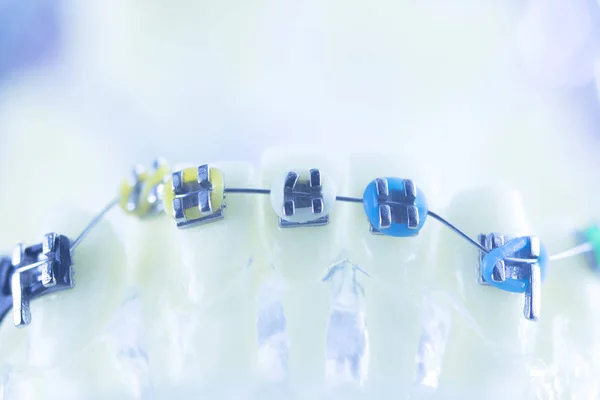 Стоматологи Ортодонты Учат Модели Зубных Пластиковых Металлических Скобок Выпрямлять Каждый — стоковое фото