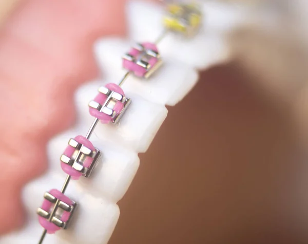 Cosmetic Dentistry Orthodontics Dental Metal Wire Teeth Brackets Teaching Student — Stock Photo, Image