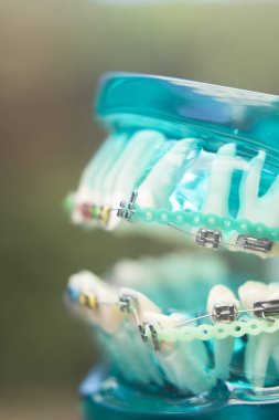 Diş diş köşeli metal