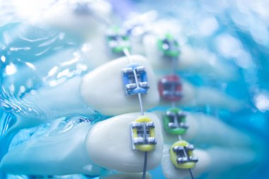 Diş diş köşeli metal