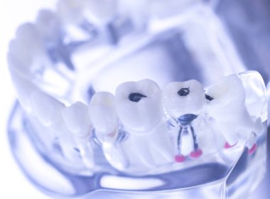 Diş diş ağız modeli