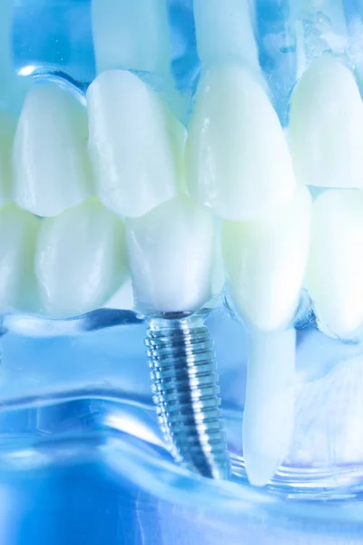 Zębów dentystycznych tytanu implant — Zdjęcie stockowe