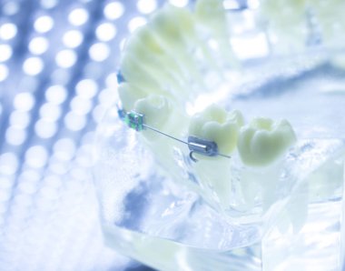 Diş diş parantez aligners