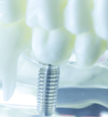 Diş titanyum implant diş