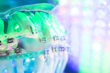 Diş diş köşeli metal