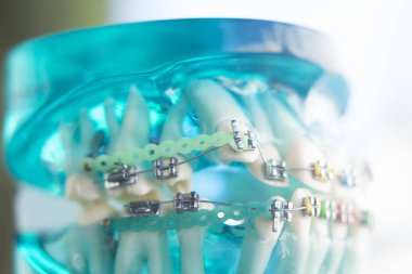 Diş diş köşeli metal