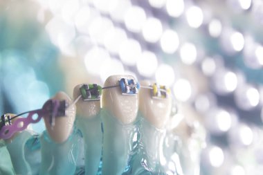 Diş diş köşeli metal