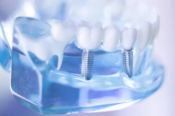 Dentistas implante dentário — Fotografia de Stock