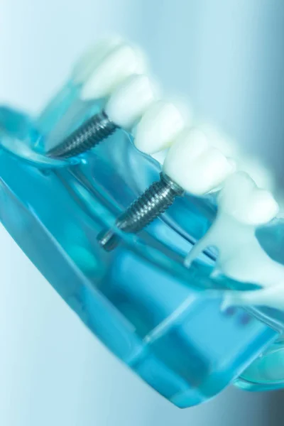 Implante dental dentario — Foto de Stock