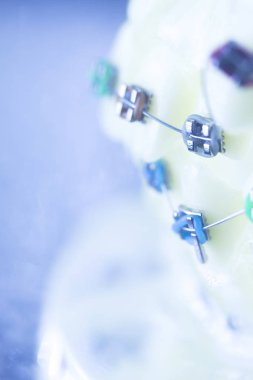 Diş diş parantez aligners